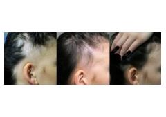 Regain Your Confidence with Best Androgenetic Alopecia Treatment